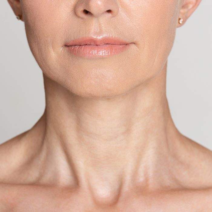 Can Neck Wrinkles Be Treated with Non-S... Thumbnail