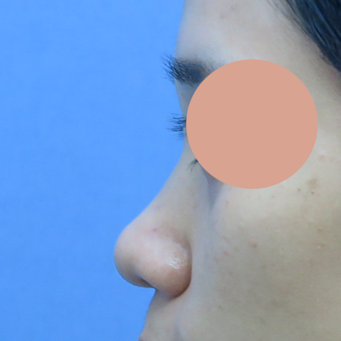 隆鼻手術，鼻子可以墊多高？ Thumbnail