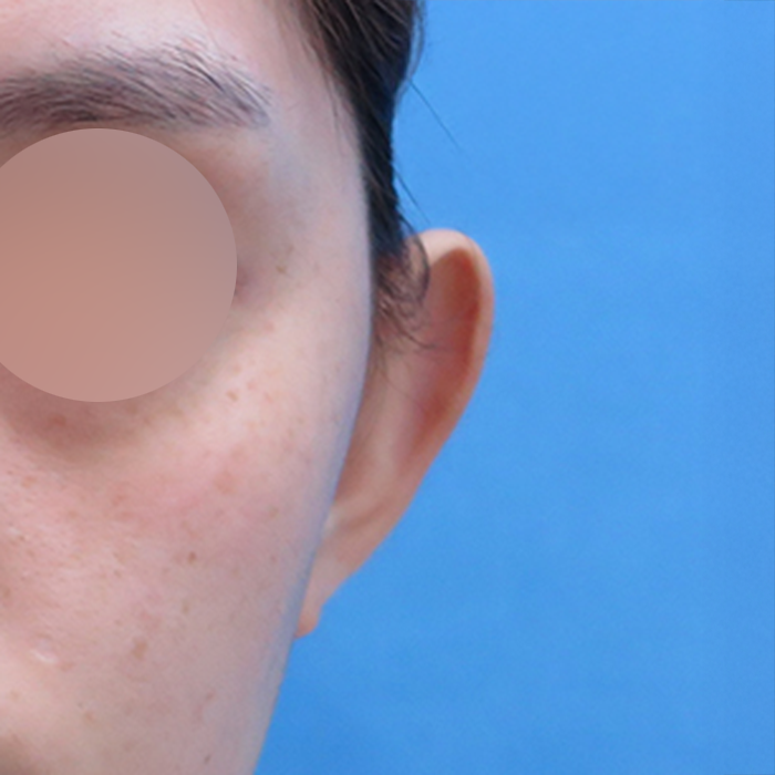 20代のお客様の立ち耳修正手術のビフォーアフター写真です。 Thumbnail