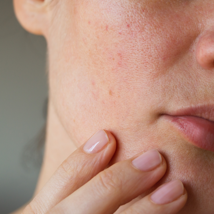 Potenza — a solution for enlarged pores... Thumbnail
