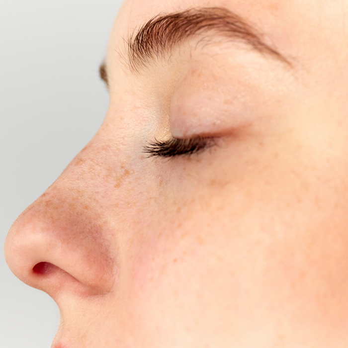 Correcting Puffiness and Hollows Withou... Thumbnail