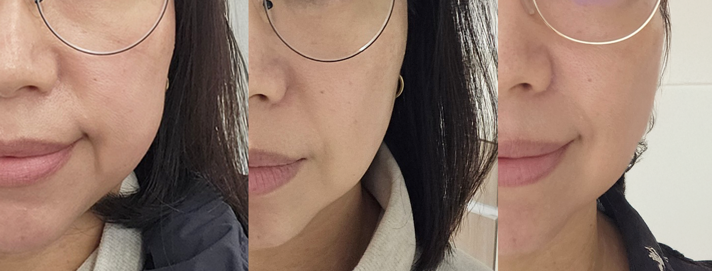 브이로어드밴스, 리프팅레이저, 초음파리프팅, 고주파리프팅, 쉬즈성형외과