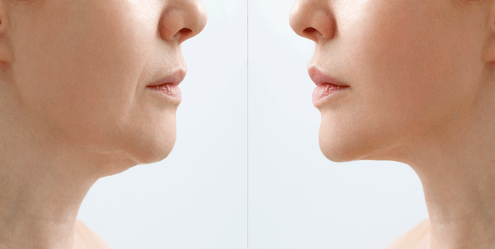 臉部贅肉和嘴角鬆弛要如何改善呢？